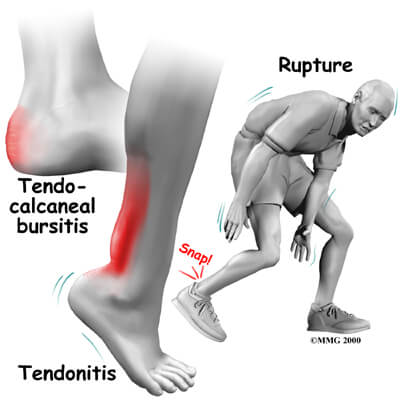 Achilles Tendonitis - degeneration of the tendon
