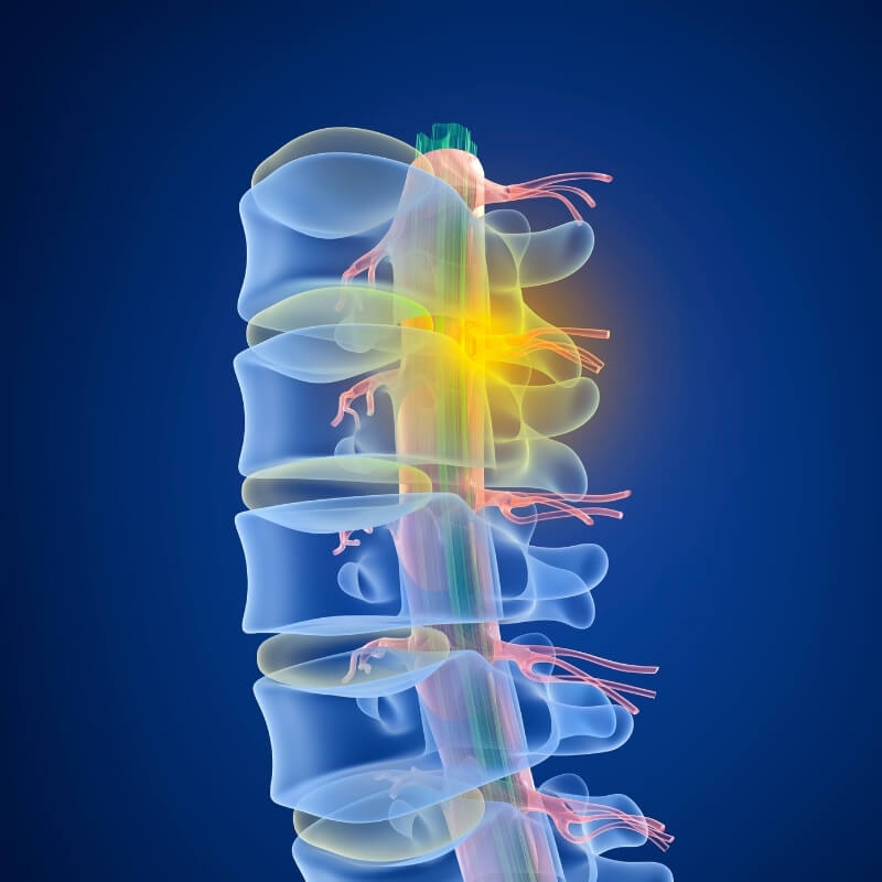 back pain vertebral compression fractures Herniated disc sciatica lower back pain benefit physiotherapy and rehabilitation clinic western sydney