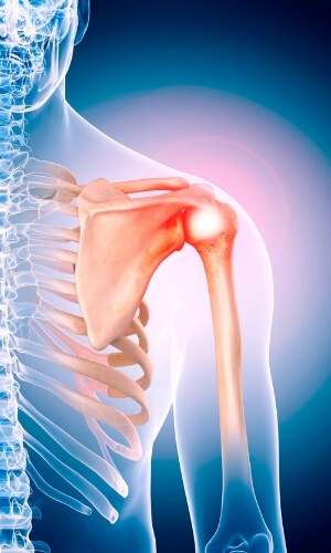 shoulder pain subacromial bursitis