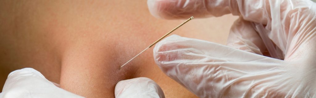 Dry Needling Physiotherapy - Benefit Physio